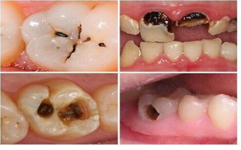 Răng bị sâu khiến vi khuẩn làm tổ kích thích vào tuỷ gây ê buốt răng cửa