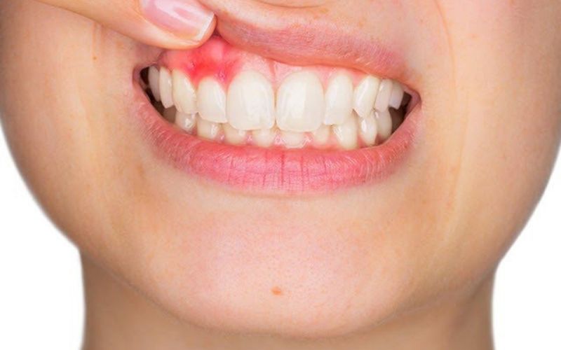 Viêm nướu(lợi) nếu không kịp thời xử lý sẽ dẫn đến hiện tượng ê buốt răng