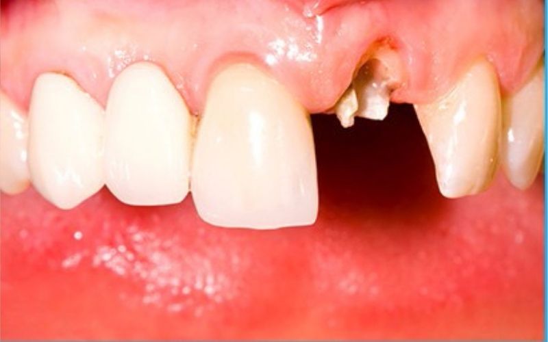 Viêm tuỷ là bệnh lý nguy hiểm về răng miệng