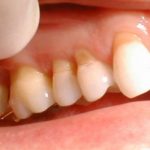 Mòn men răng khiến răng trở nên yếu và dễ gãy rụng.