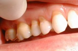 Mòn men răng khiến răng trở nên yếu và dễ gãy rụng.