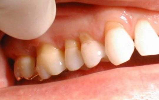 Mòn men răng khiến răng trở nên yếu và dễ gãy rụng.