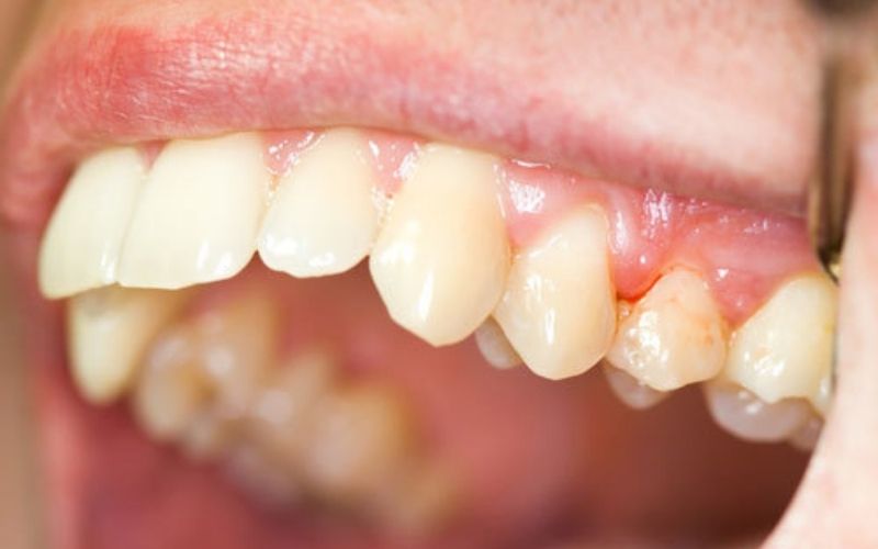 Viêm nha chu nếu không được điều trị kịp thời sẽ có hại đến sức khoẻ răng miệng.