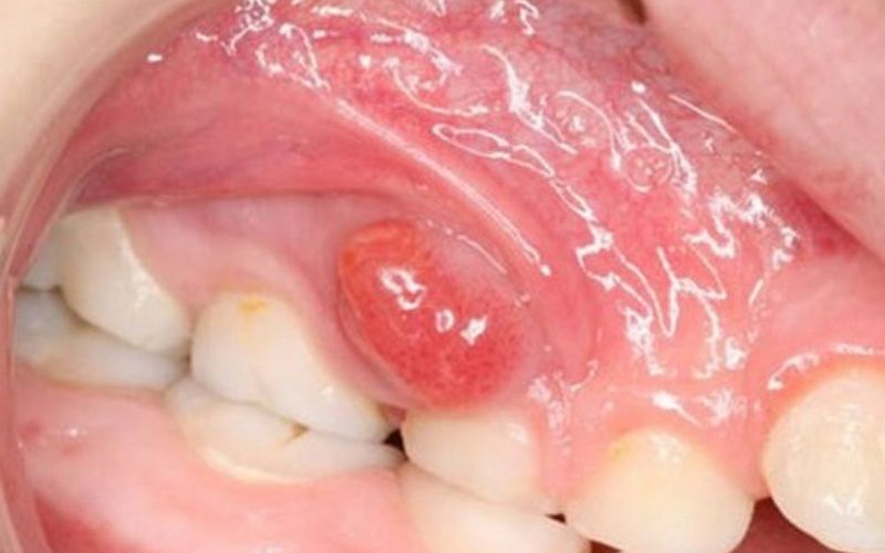 viêm tuỷ ở trẻ gây nguy hiểm đến răng vinh viễn và ảnh hưởng đến hệ thần kinh non yếu của trẻ