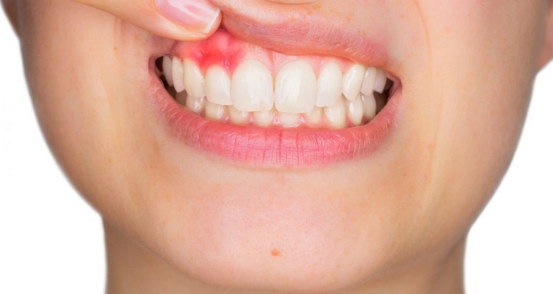 Áp xe răng là một tình trạng chỉ khu vực đang bị sưng đau và có xuất hiện túi mủ hay đã chảy mủ