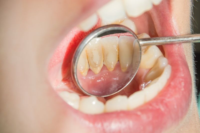 Cạo vôi răng đã bám dính lâu ngày rất dễ bị ê răng