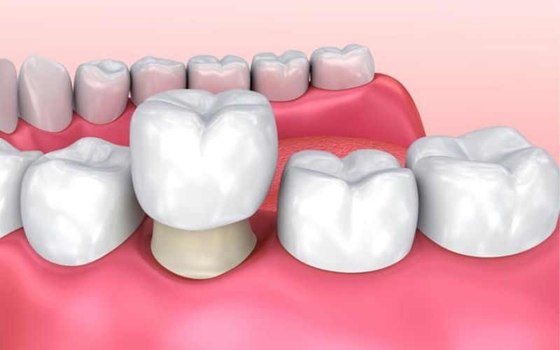 Bọc răng sứ tăng cường hệ miễn dịch bảo vệ cho răng