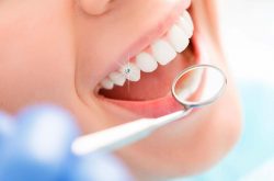 Bọc răng sứ thẩm mỹ là gì? Có hiệu quả không?