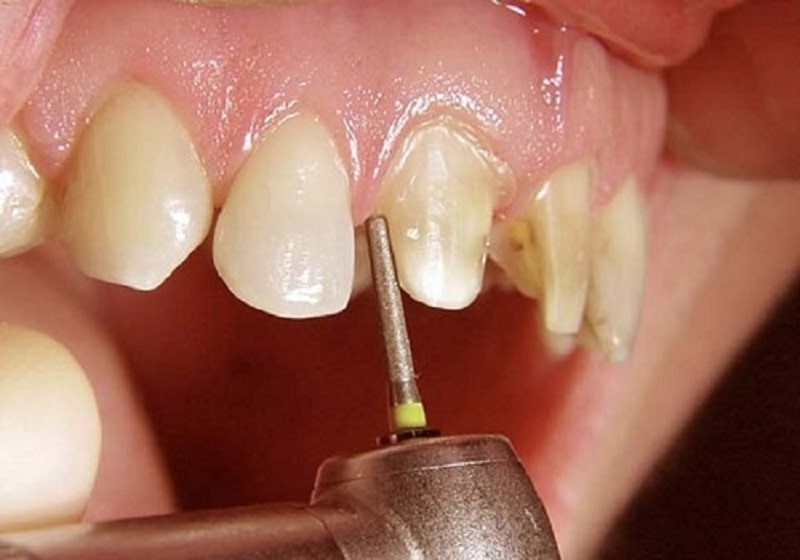 Công đoạn mài răng có thể khiến bạn khó chịu, ê buốt chứ không đau