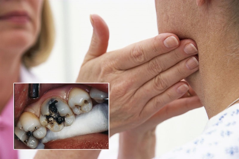 Đau răng nổi hạch ở cổ nếu do sâu răng thì cần can thiệp điều trị ngay