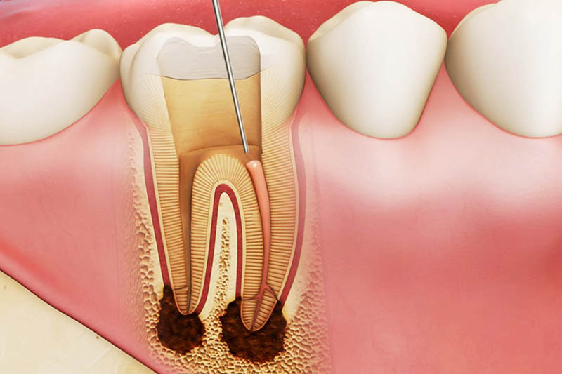 Viêm tủy răng gây ê buốt răng sau khi trám