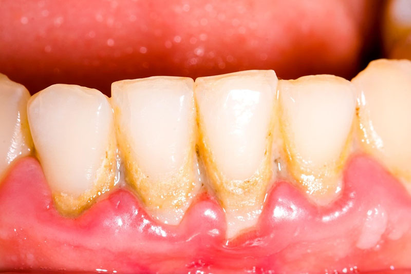 Cao răng hình thành do những mảng bám trên răng không được làm sạch