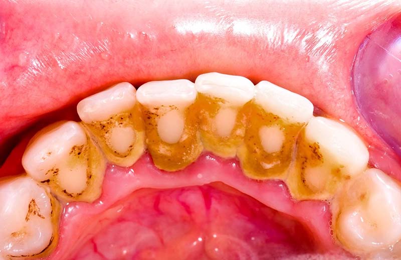 Cao răng gây ra nhiều bệnh nghiêm trọng về răng và nướu