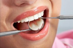 Lấy cao răng là gì? Những thông tin quan trọng bạn cần biết về lấy cao răng