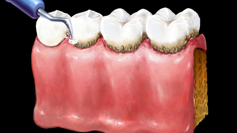Quy trình lấy cao răng được thực hiện trong 4 bước