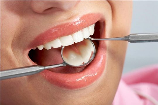 Lấy cao răng là gì? Những thông tin quan trọng bạn cần biết về lấy cao răng
