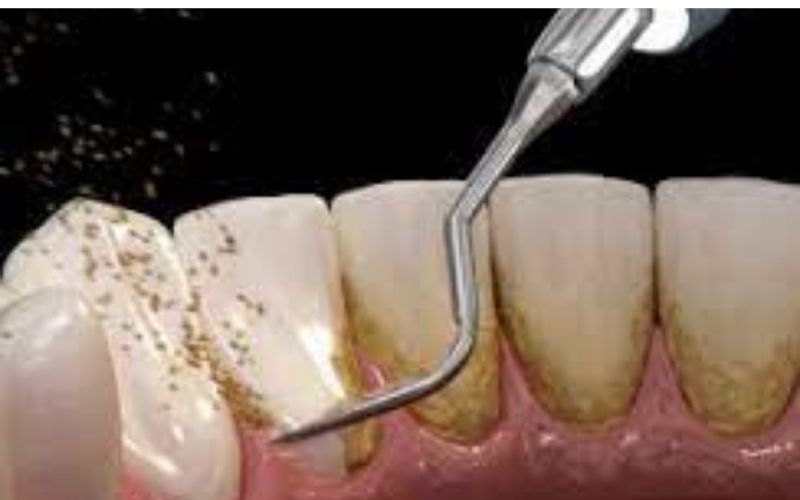 Lấy cao răng giúp loại bỏ các mảng bám cho răng hạn chế tối đa vi khuẩn xâm nhập vào răng