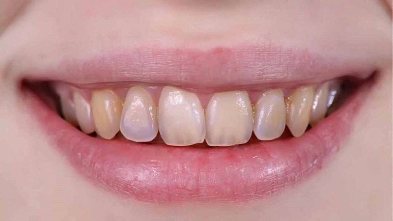 Men răng là một phần vô cùng quan trọng của răng miệng