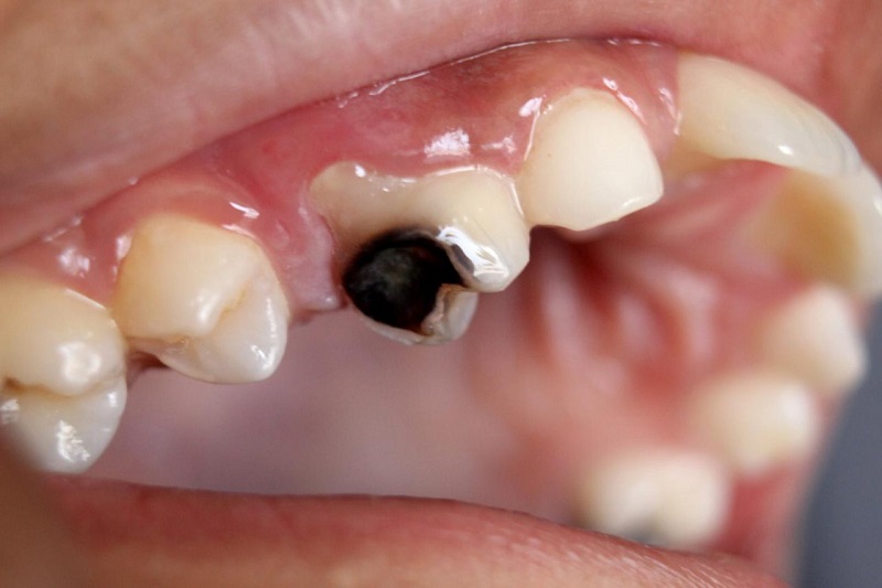 Áp xe răng do bệnh nha khoa không được điều trị kịp thời