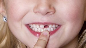 Nhổ răng sữa cho bé: Cách thực hiện đúng và một số vấn đề cha mẹ cần lưu ý