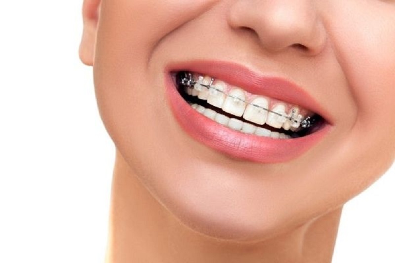 Niềng răng là phương pháp chỉnh nha được áp dụng phổ biến