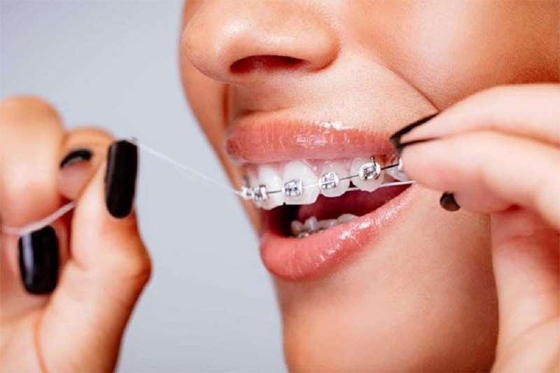 Vệ sinh răng miệng sạch sẽ, đúng cách để đảm bảo hiệu quả chỉnh nha