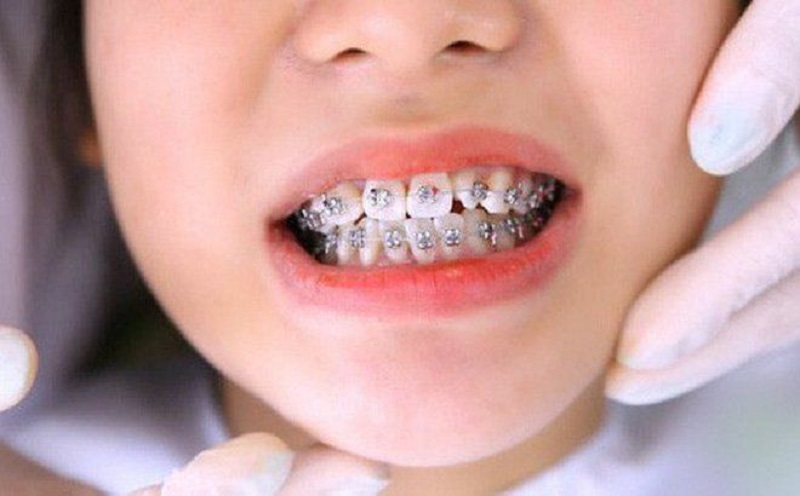 Để có hàm răng đẹp, bạn phải đeo niềng trong 18 – 24 tháng