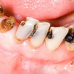 Quá trình sâu răng phát triển nhanh gây ảnh hưởng nghiêm trọng