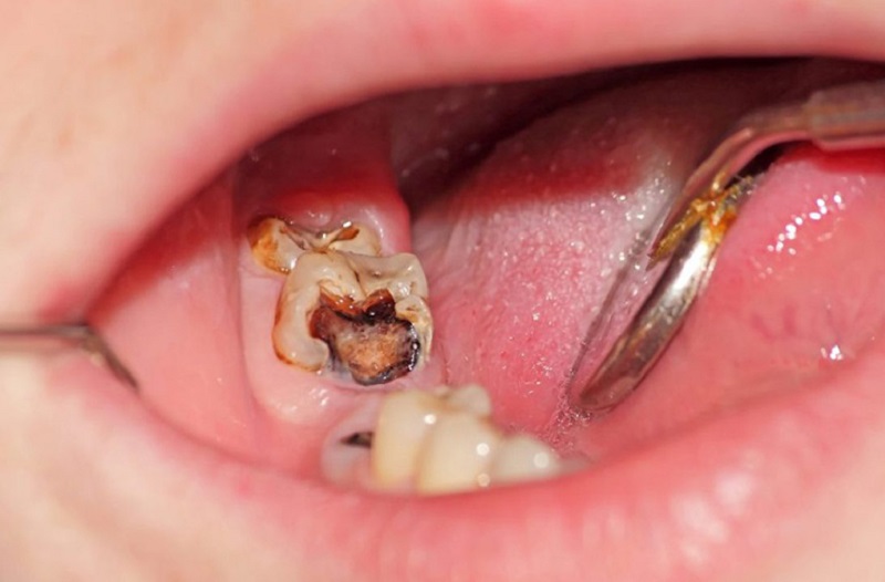 Sâu răng gây viêm tủy làm ảnh hưởng tới khả năng nhai