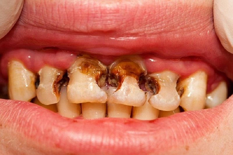 Răng bé bị ố vàng sẽ tăng nguy cơ bị sâu răng