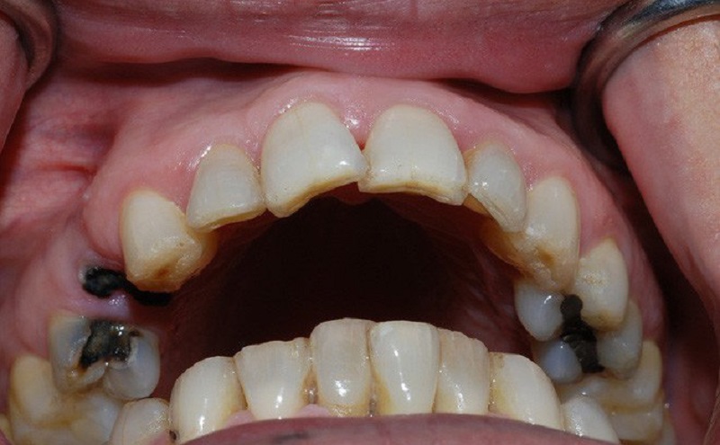 Sâu răng là bệnh lý về răng miệng thường ặp, nhất là ở trẻ nhỏ