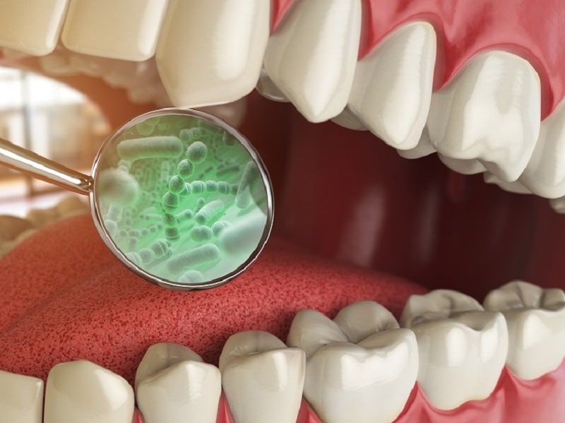 Vi khuẩn trú ngụ trên răng khiến răng bị sâu
