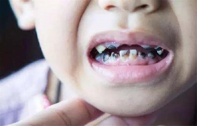 Khi răng bị sâu, chúng rất dễ bị vỡ vụn lúc ăn nhai