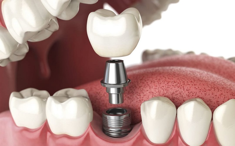Kỹ thuật cấy ghép răng Inplant