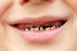 Sún răng