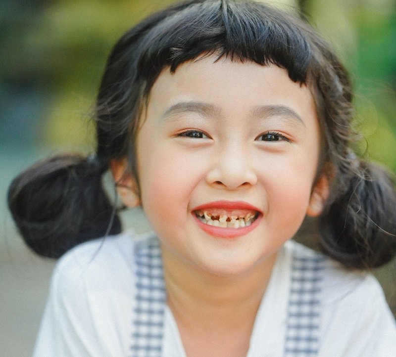 Sún răng là tình trạng phổ biến xảy ra ở trẻ từ 1 - 3 tuổi