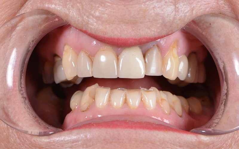 Thiếu sản men răng là bệnh lý cảnh báo men răng yếu và có thể ảnh hưởng lớn tới cấu trúc răng