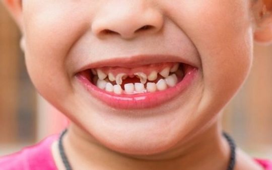 Trẻ bị đau răng sẽ làm con bạn luôn ôm mặt khó chịu ảnh hưởng đến sinh hoạt hằng ngày của trẻ