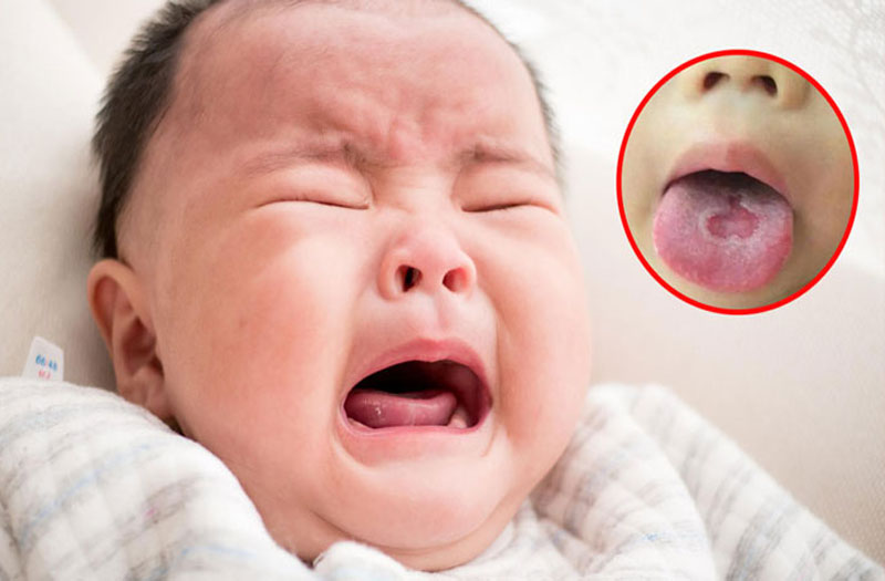 Trẻ nhỏ mắc bệnh tưa miệng