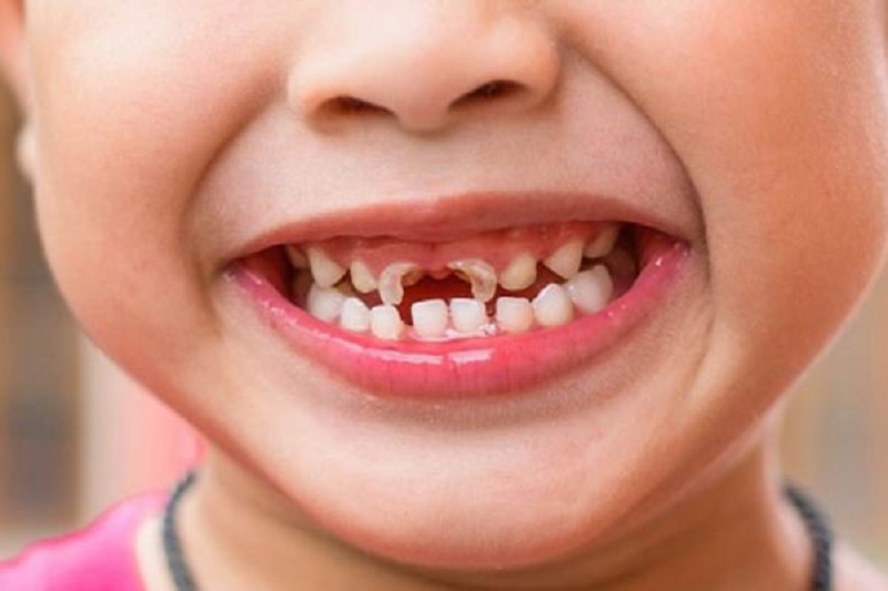 Chậm mọc răng ở trẻ do vi khuẩn có thể gia tăng nguy cơ trẻ bị sâu răng về sau 