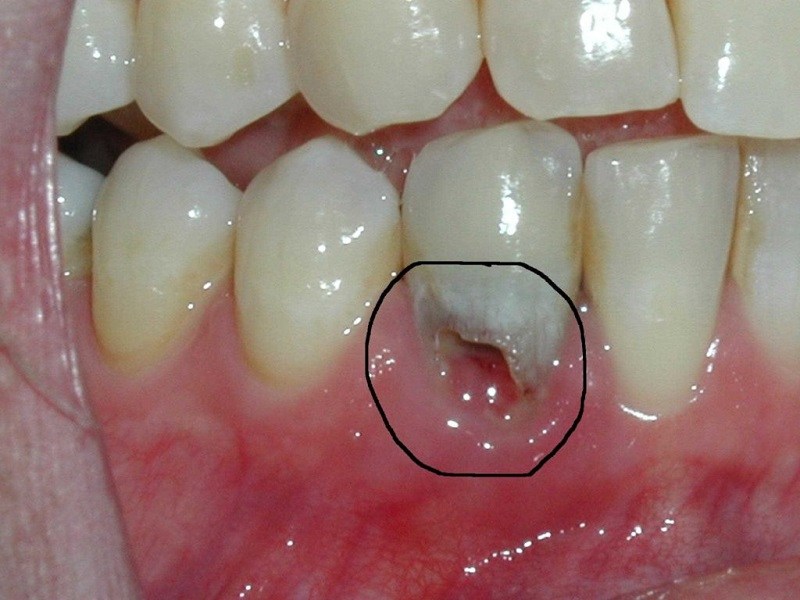 Viêm chân răng là một dạng bệnh lý nha khoa tương đối nguy hiểm