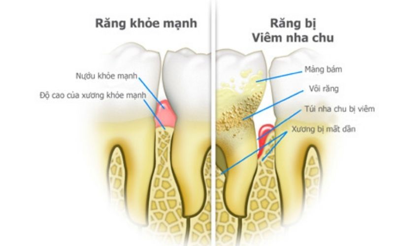 Viêm nha chu gây ê buốt răng hàm là dấu hiệu cần phải đề phòng gấp.