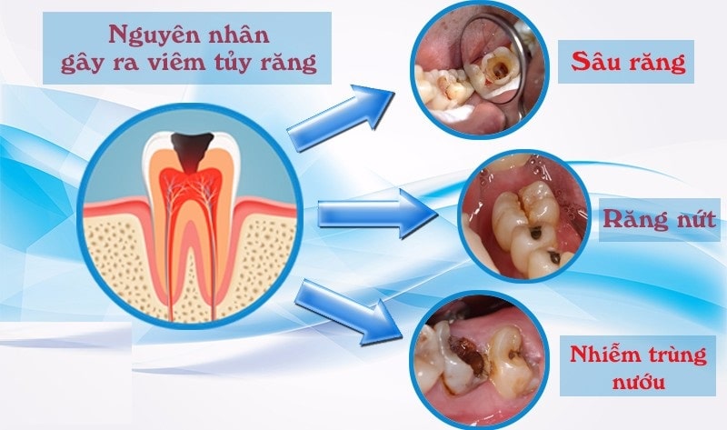 3 nguyên nhân chính khiến tủy răng bị viêm