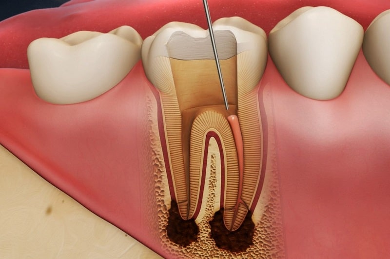 Chân răng đã bị hoại tử do viêm tủy