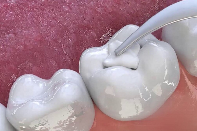 Trám răng là kỹ thuật được áp dụng phổ biến trong nha khoa