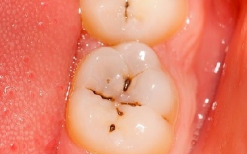 Ê buốt răng hàm do bị viêm tủy