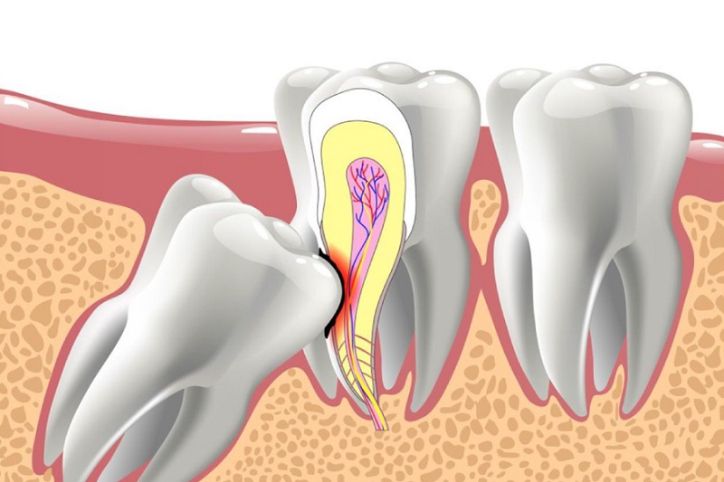 Mọc răng khôn có thể là nguyên nhân khởi phát bệnh