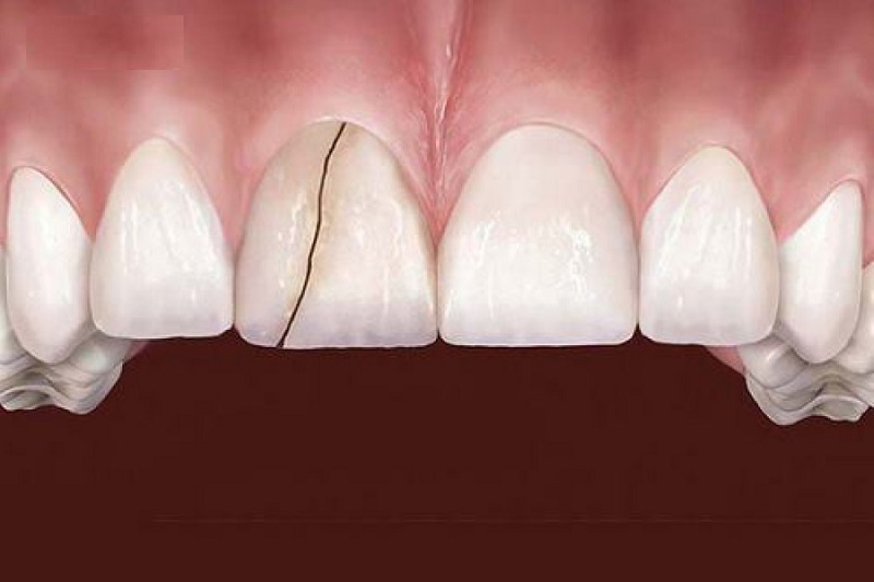 Răng bị sứt mẻ cũng có thể là nguyên nhân gây đau răng dẫn đến đau nửa đầu nhân gây 