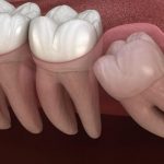 Đau răng khôn là mối lo cho các răng khác trong cung hàm