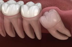 Đau răng khôn là mối lo cho các răng khác trong cung hàm